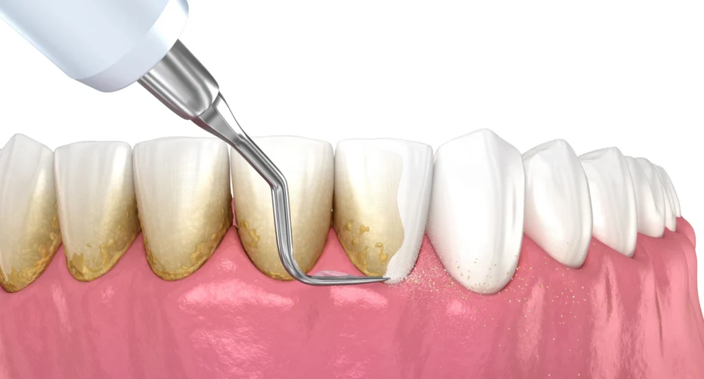 Détartrage et surfaçage radiculaire