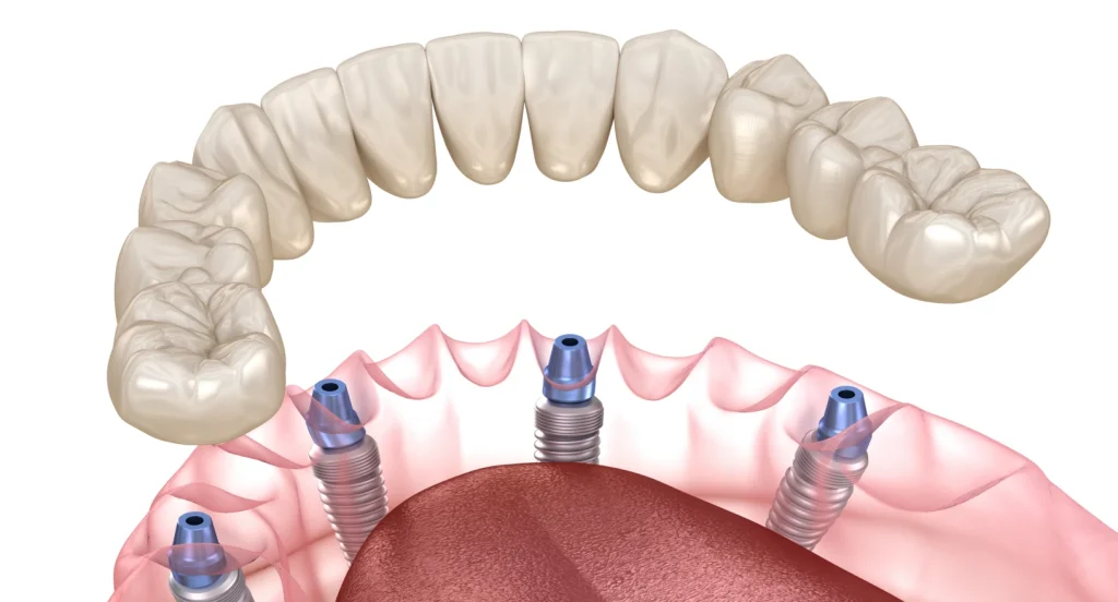 Prothèse sur implant