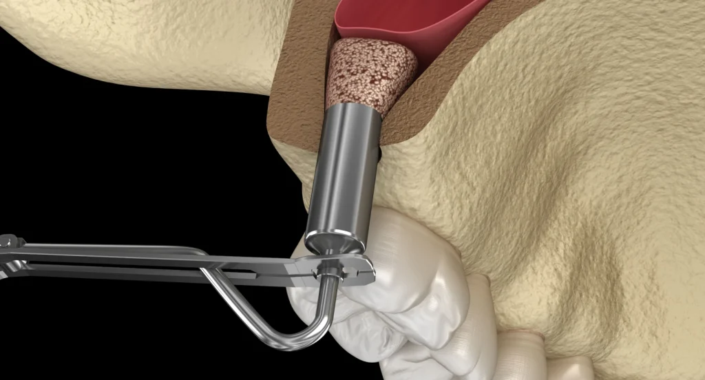 Sinus lift