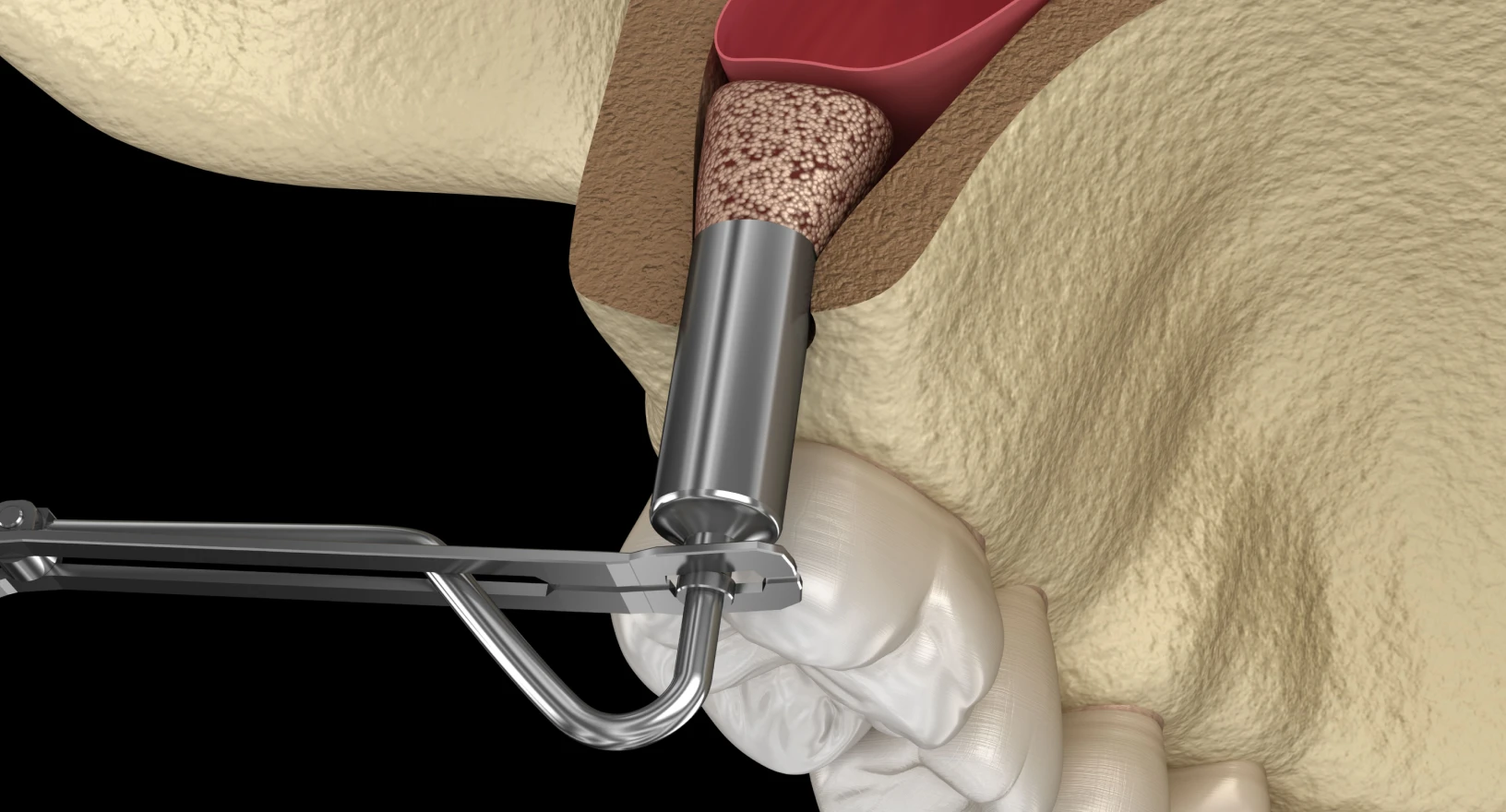 cabinet-dentaire-pins-sinus-lift