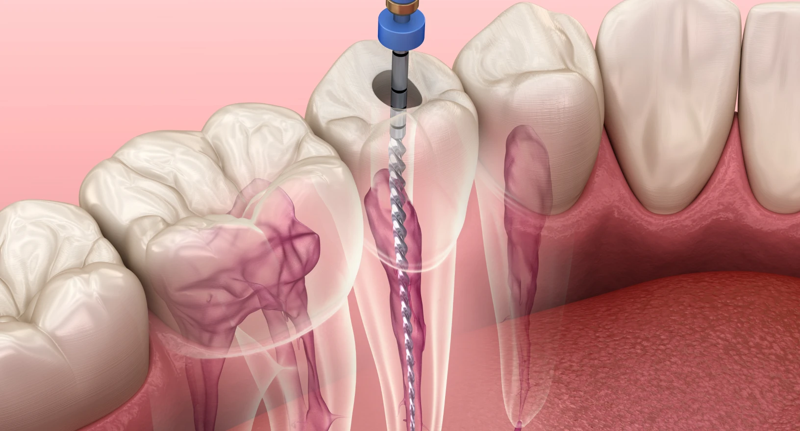 clinique-pins-endodontie