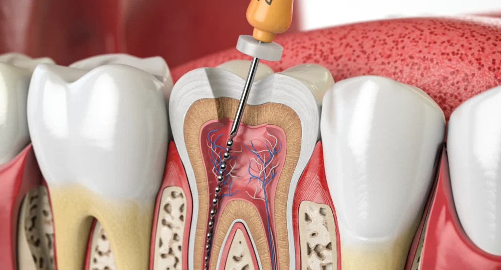 Retraitement de racine sous microscope