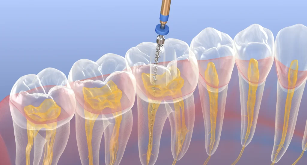 Microchirurgie endodontique